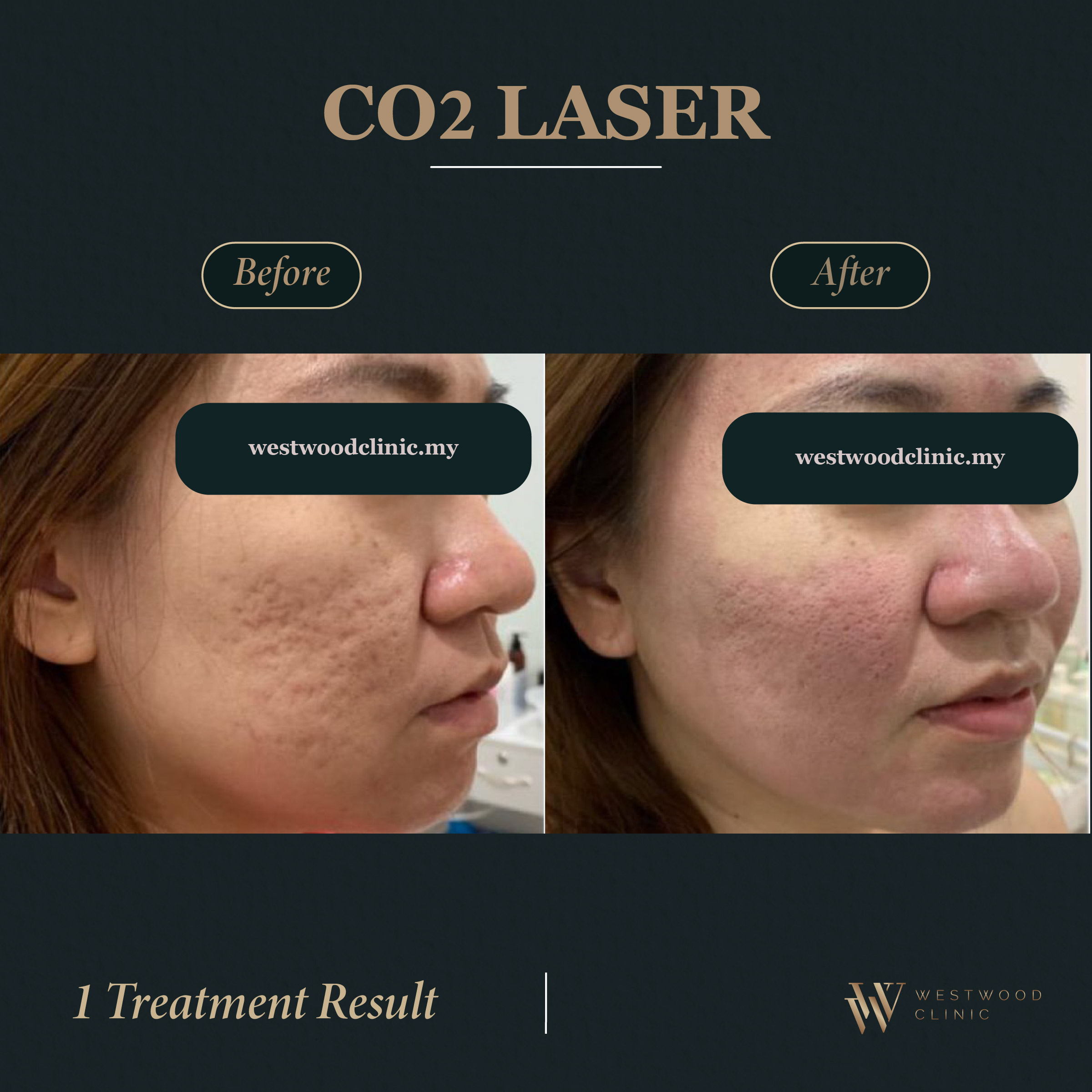 Co2Laser l Westwood Clinic