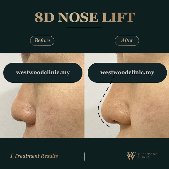 8D Nose Lift l Westwood Clinic