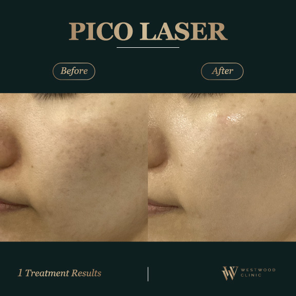Pico Laser l Westwood Clinic