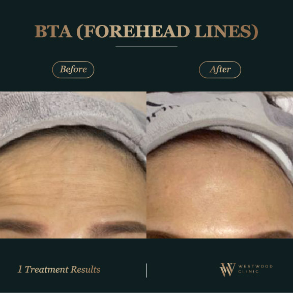 BTA l Westwood Clinic