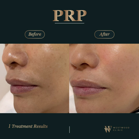 PRP l Westwood Clinic