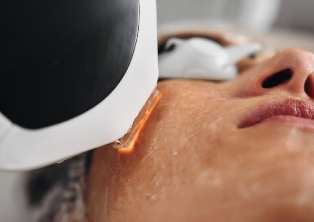 laser for pigmentation