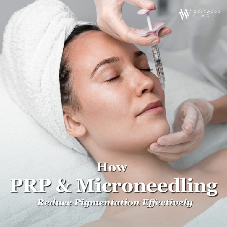 How PRP and Microneedling Reduce Pigmentation Effectively