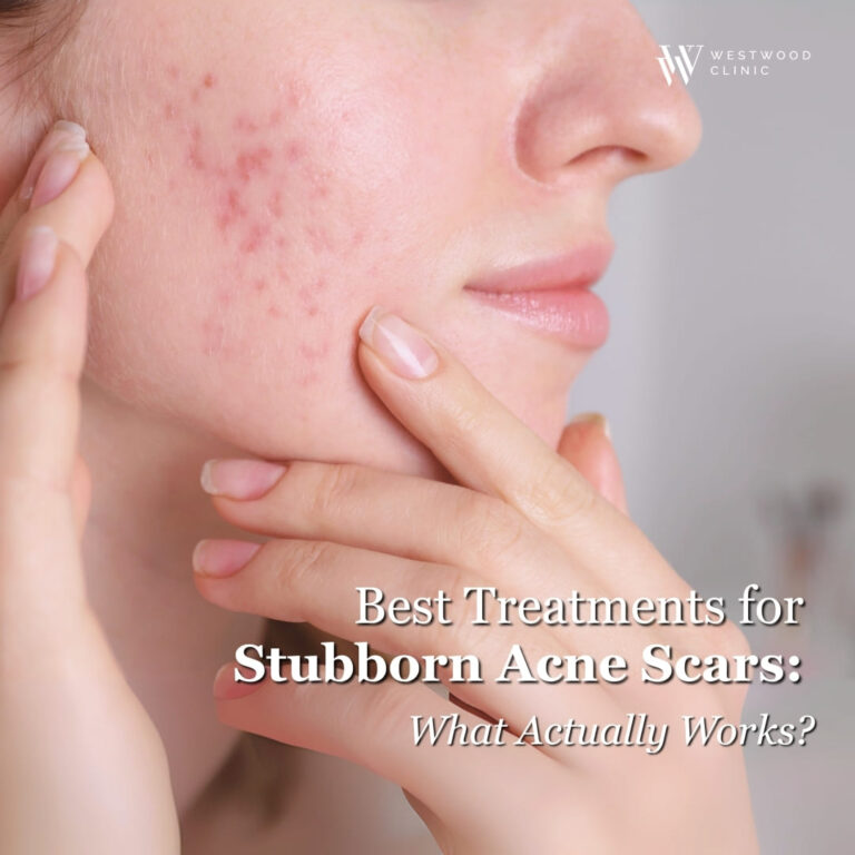 Pico Laser for Stubborn Acne Scars: Effective Solutions