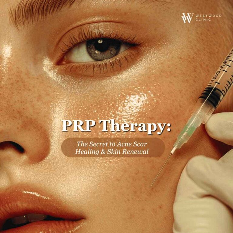 PRP Therapy: The Secret to Acne Scar Healing & Skin Renewal