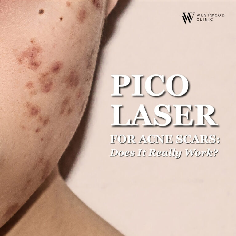 Pico Laser for Acne Scars: Does It Really Work?
