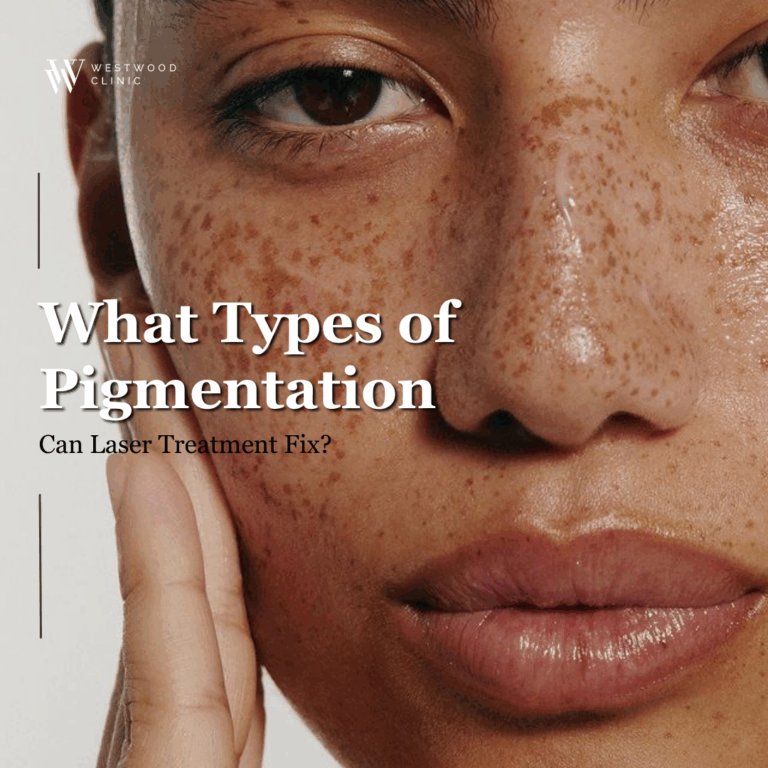 What Types of Pigmentation Can Laser Treatment Fix?